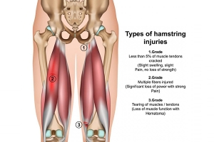 All About Hamstring Injuries with Dr. Catherine Logan