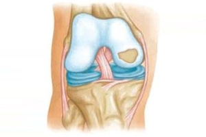 Dr. Catherine Logan Discusses Knee Cartilage Surgery