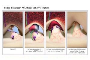 Dr. Logan Discusses ACL Repair: All About the BEAR to Restore the ACL