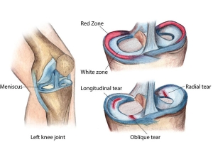 Effective Treatment Methods for Meniscus Root Tear