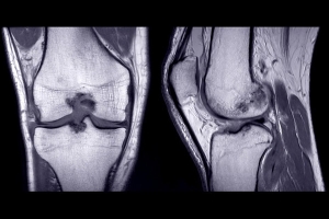 How do I manage an ACL tear in a young athlete?
