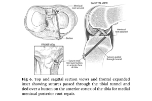 Meniscus Root Repair Rehab: The Path to Recovery