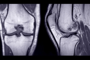 PreHab Before ACL Surgery: Which Exercsies?
