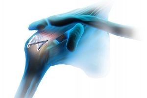 Preparing for Rotator Cuff Surgery