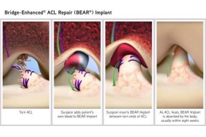 Tell Me About the BEAR ACL Surgery