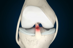 The Latest Advancements in ACL Surgery and Treatment