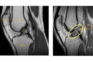 Which ACL Graft is Best for You?