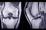 ACL Injuries on the Mountain: Next Steps