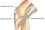 ACL Reconstruction: Graft Choices