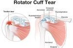Does PRP Enhance Rotator Cuff Surgery/Healing?