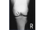 How Do I Treat My Cartilage Injury?