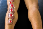 Is Cupping Helpful for Calf Soreness/Gastroc Strains?