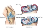 Meniscus Tears: To Operate or Not? With Dr. Catherine Logan