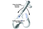OATS vs OCA for Cartilage Injuries of the Knee