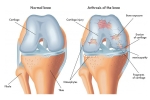 Revision Osteochondral Allograft Transplantation