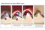 Tell Me About the BEAR ACL Surgery