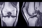 What Imaging is Needed for ACL Revision?