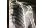 What is a Bony Bankart Injury (Shoulder Dislocation)?