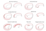 What is a Discoid Meniscus?
