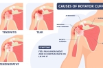 What is a Rotator Cuff Tear?