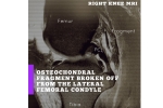 What is an OCD lesion?