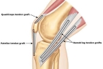 Which Graft Should I Choose for ACL Surgery?